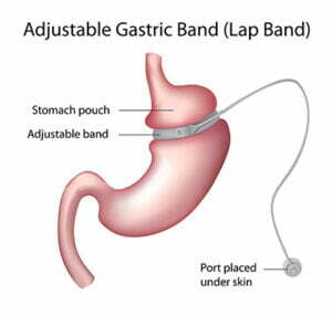 gastric-band-300x286