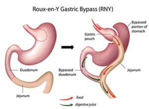 gastric-bypass