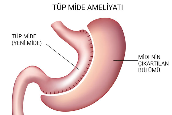 tüp mide ameliyatı çizim ile anlatımı